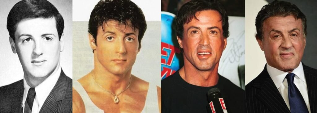 Sylvester Stallone Plastic Surgery